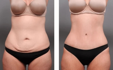 Recovery Timeline After Tummy Tuck Dubai