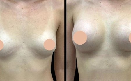 Breast Augmentation Revision Surgery: When and Why You Should Consult the Best Breast Augmentation Surgeons in Dubai