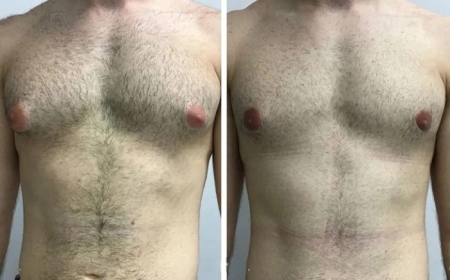 Why Men Trust the Best Doctors in Dubai for Gynecomastia Solutions
