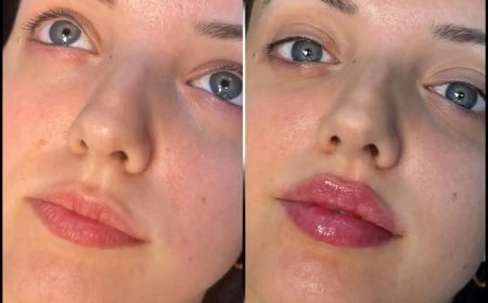 How the Best Doctors in Dubai for Fillers Can Boost Your Facial Symmetry