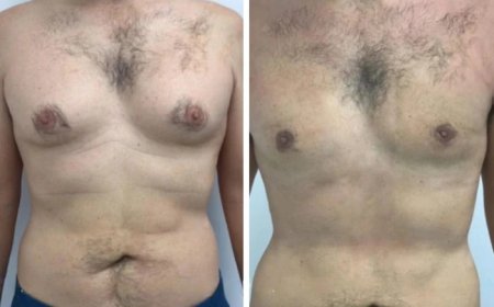 Why Consult a Specialist for Gynecomastia in Dubai Treatment