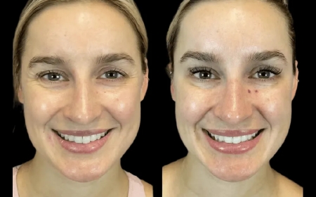 Best Doctors in dubai for Botox: What Sets Them Apart from the Rest