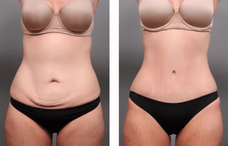 Recovery Timeline After Tummy Tuck Dubai