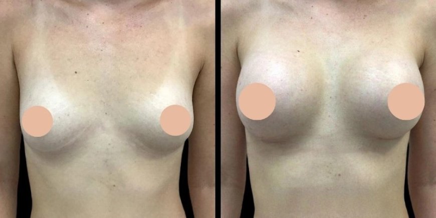 Breast Augmentation Revision Surgery: When and Why You Should Consult the Best Breast Augmentation Surgeons in Dubai