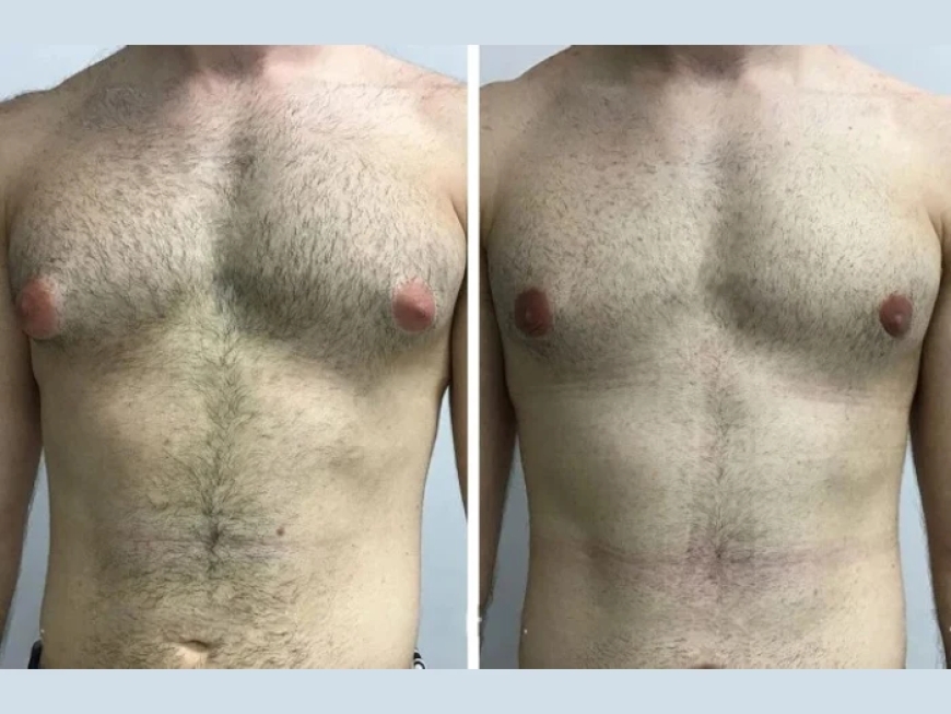 How to Book a Consultation with the Best Gynecomastia Surgeons in Dubai