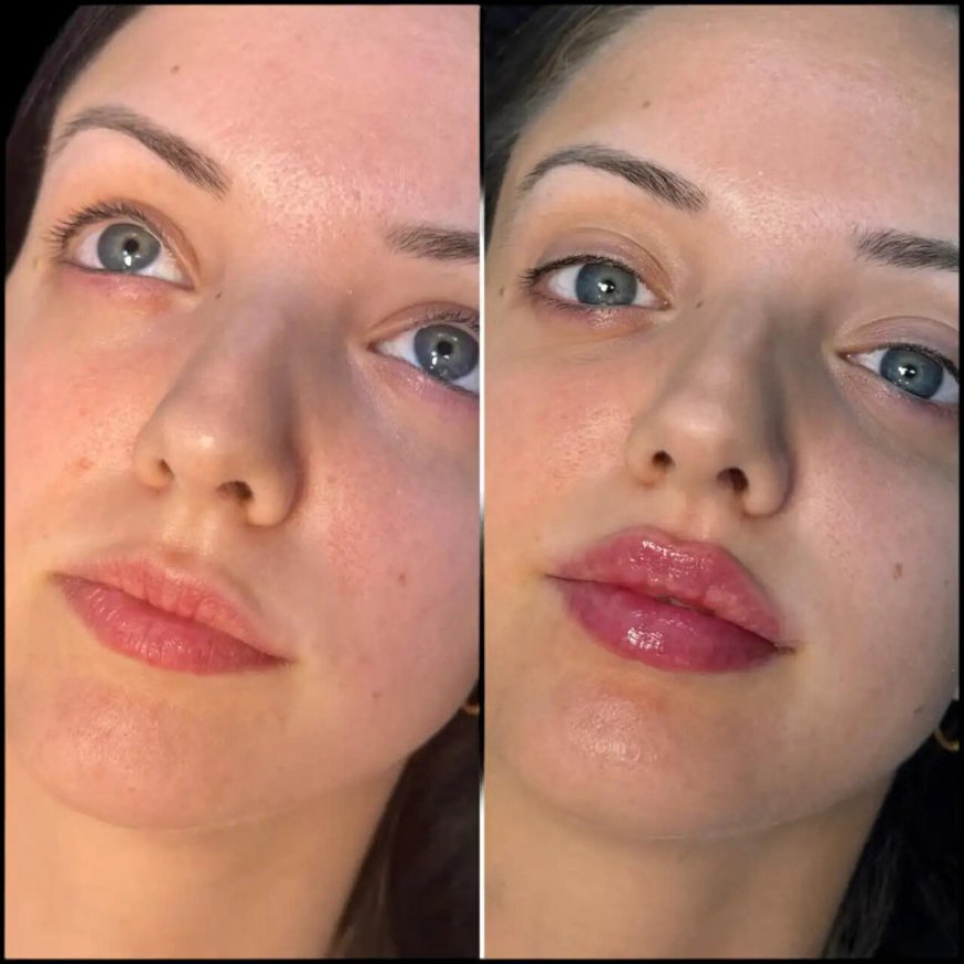 How the Best Doctors in Dubai for Fillers Can Boost Your Facial Symmetry