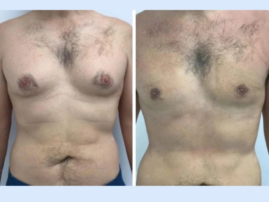Why Consult a Specialist for Gynecomastia in Dubai Treatment