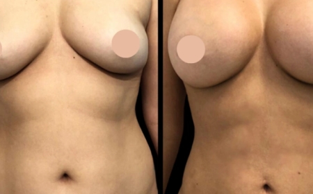 Why Breast Augmentation Surgery in Dubai Is Worth It