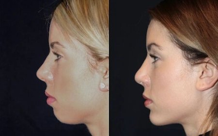 Chin Fillers in Dubai: Safe, Effective, and Affordable Options