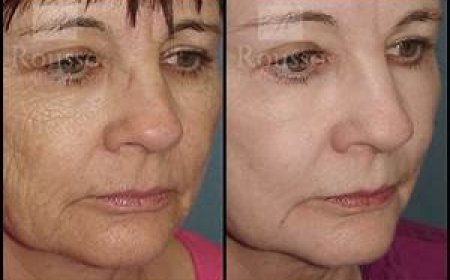 Chemical Peel Before and After: How Long Do Results Last?