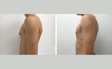 The Best Gynecomastia Surgeon in Dubai: Your Key to Confidence and Comfort