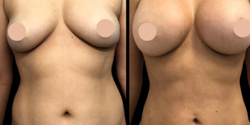 Why Breast Augmentation Surgery in Dubai Is Worth It