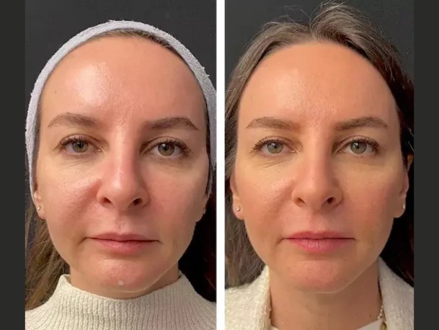 Best Aesthetic Clinics in Dubai for Mesotherapy: Where Beauty Meets Expertise