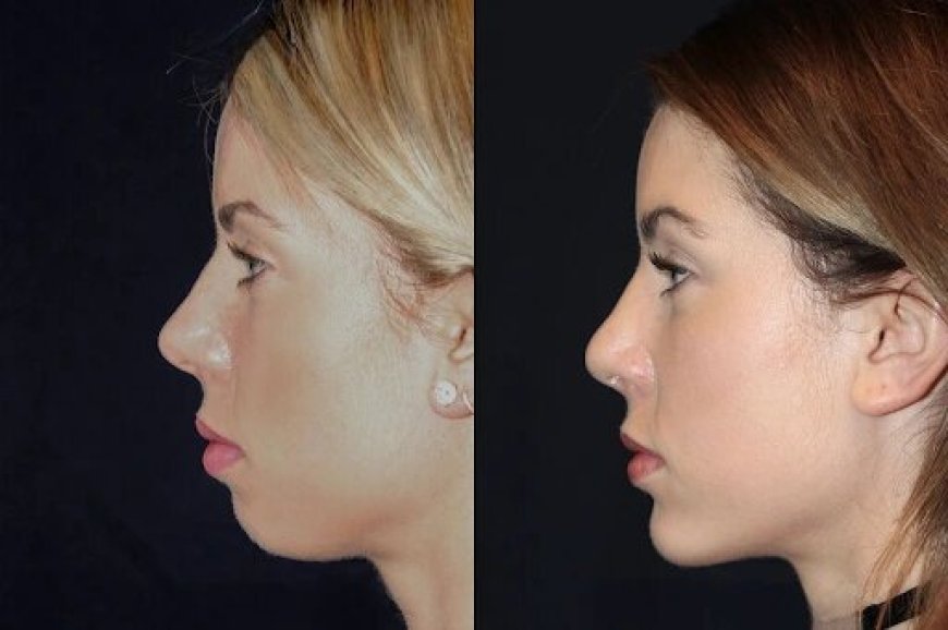 Chin Fillers in Dubai: Safe, Effective, and Affordable Options