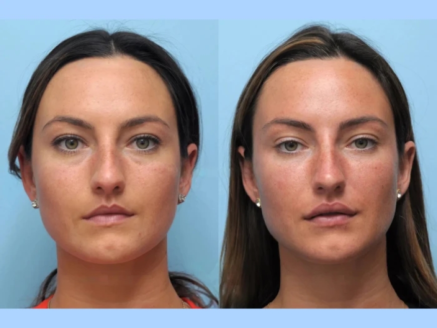 Questions to Ask the Best Plastic Surgeons in Dubai Before Your Thread Lift Procedure
