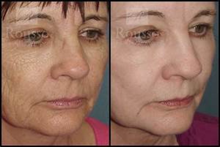 Chemical Peel Before and After: How Long Do Results Last?