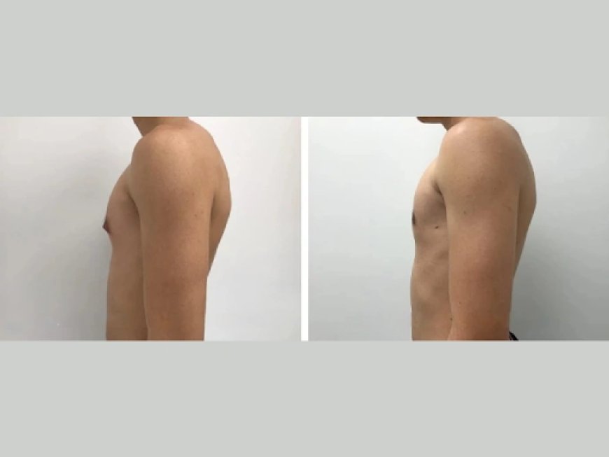 The Best Gynecomastia Surgeon in Dubai: Your Key to Confidence and Comfort