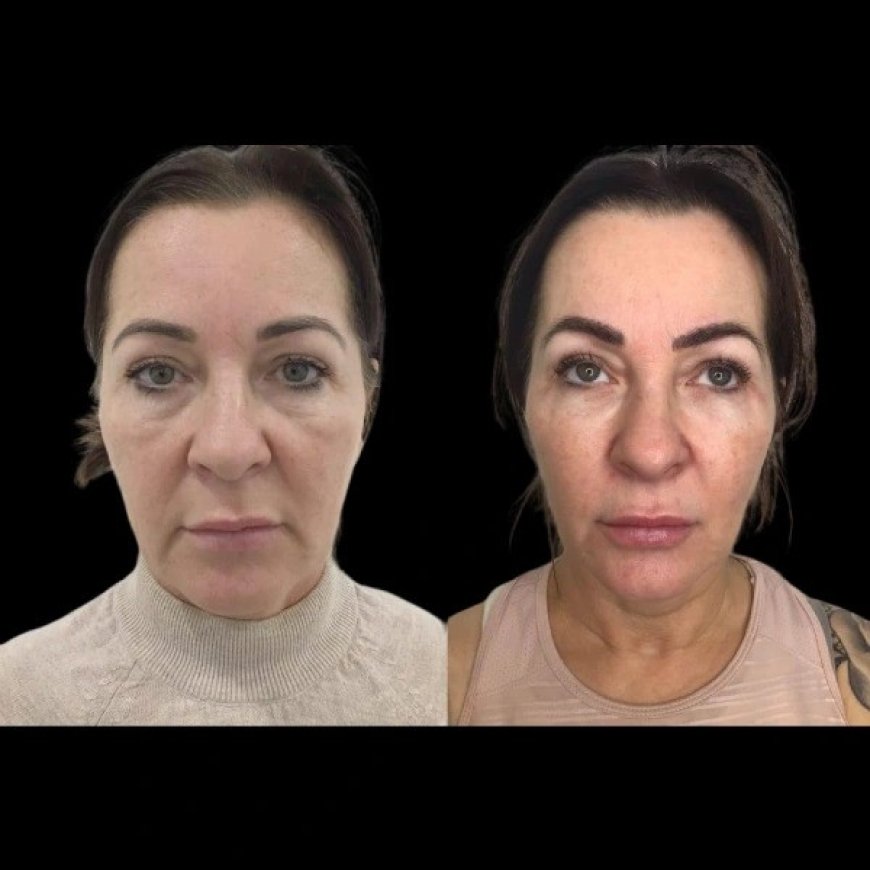 Top Benefits of Profhilo with the Best Plastic Surgeon in Dubai
